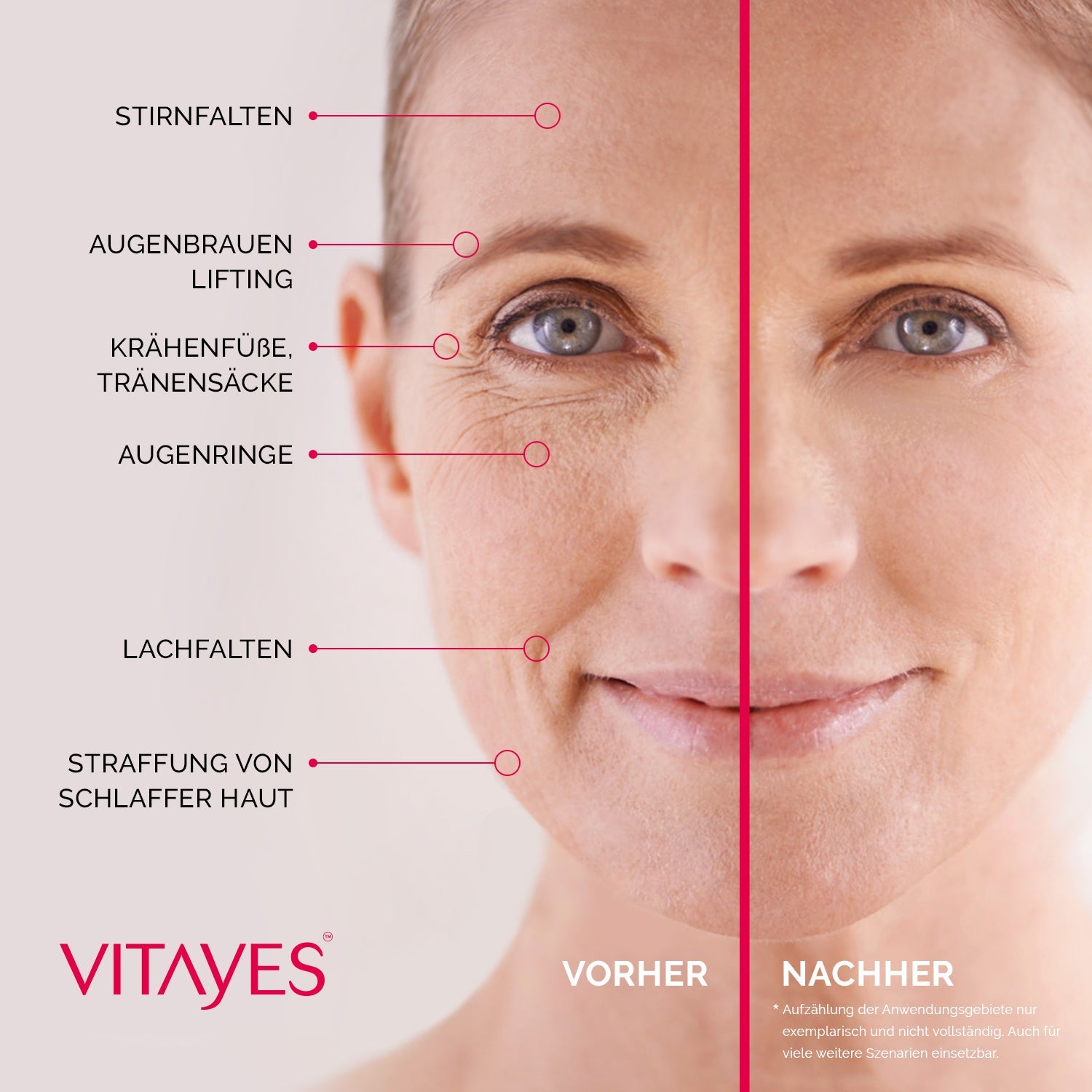 Instant Ageback Lifting-Creme gegen Tränensäcke und Falten, sichtbare Hautstraffung, Vitayes, klinisch bestätigt