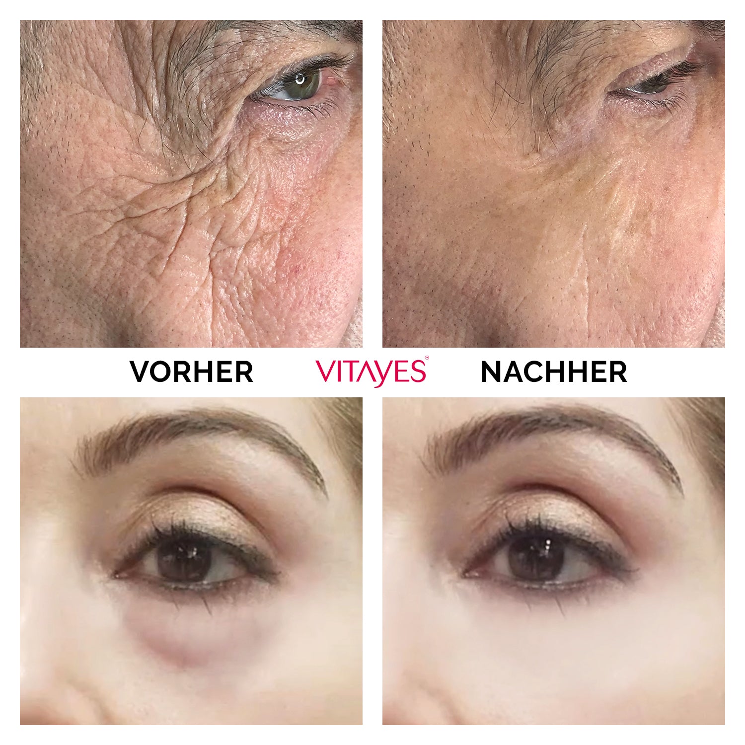 Instant Ageback Lifting-Creme gegen Tränensäcke und Falten von Vitayes, klinisch bestätigt, auf der Haut aufgetragen.